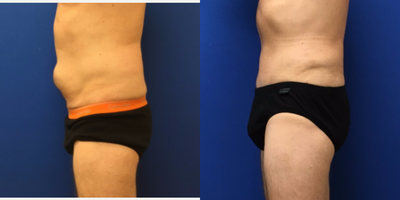 Tummy Tuck before and after photo