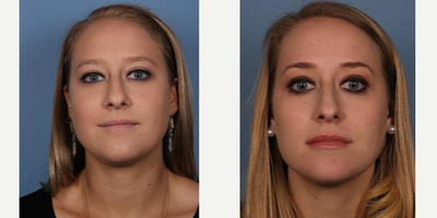Dermal Fillers before and after photo