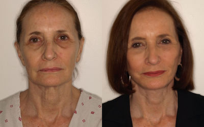 Facelift before and after photo