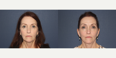 Facelift before and after photo