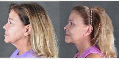 Facelift before and after photo