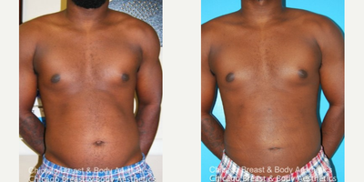 Smart Lipo before and after photo