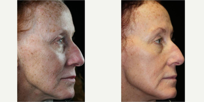 Fraxel Laser before and after photo
