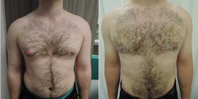 Gynecomastia Surgery before and after photo