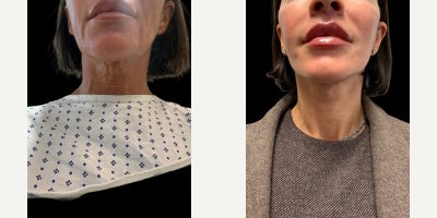 Neck Lift before and after photo