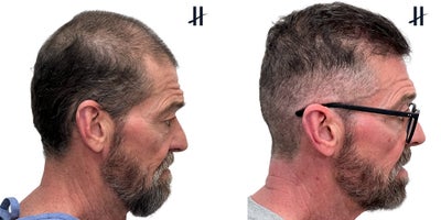PRP for Hair Loss before and after photo