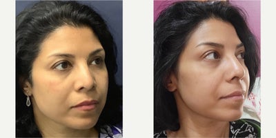 Rhinoplasty before and after photo