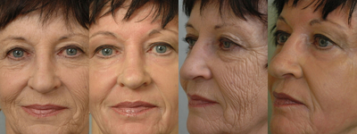 Skin Rejuvenation before and after photo