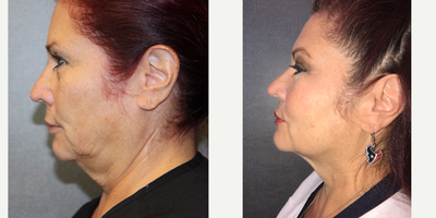 FaceTite before and after photo