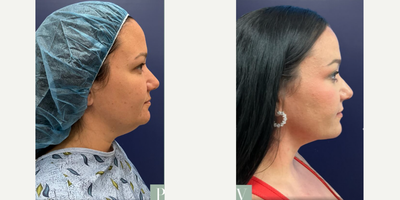 FaceTite before and after photo
