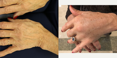 Hand Rejuvenation before and after photo