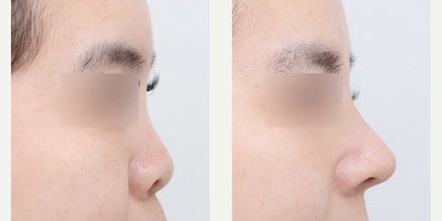 Rhinoplasty before and after photo