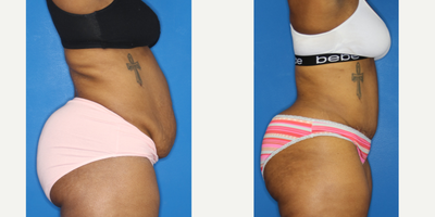 Tummy Tuck before and after photo