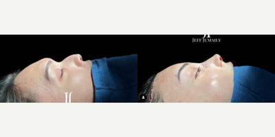 Facial Feminization Surgery before and after photo