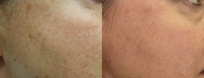 Laser Resurfacing before and after photo