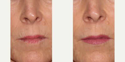 Lip Fillers before and after photo