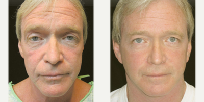QuickLift before and after photo