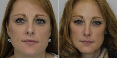 Botox before and after photo