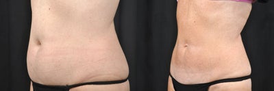 CoolSculpting before and after photo