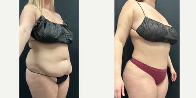 Diastasis Recti Repair before and after photo