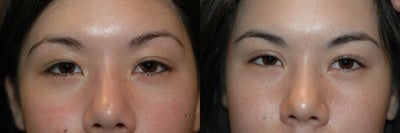 Double Eyelid Surgery before and after photo