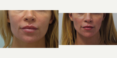 Jaw Reduction before and after photo