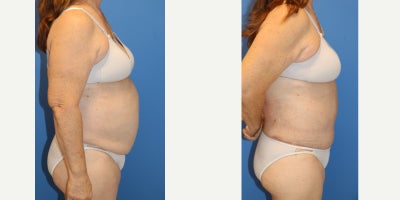 Liposuction before and after photo