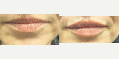Restylane Silk before and after photo
