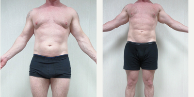 Liposuction before and after photo