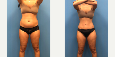 Liposuction before and after photo