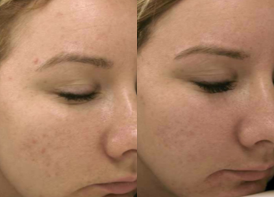 Microneedling before and after photo