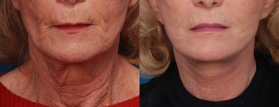Neck Lift before and after photo