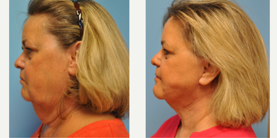 Neck Lift before and after photo