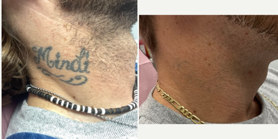 Tattoo Removal before and after photo