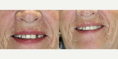 Tooth Repair before and after photo
