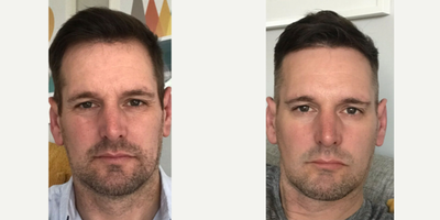 Botox before and after photo