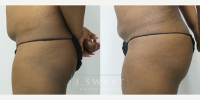 Brazilian Butt Lift before and after photo