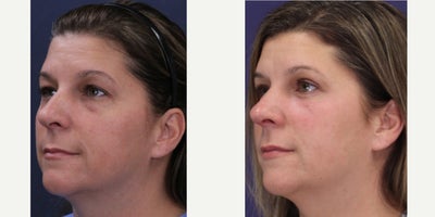 Facial Fat Transfer before and after photo