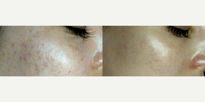 Microneedling before and after photo