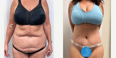 Tummy Tuck before and after photo