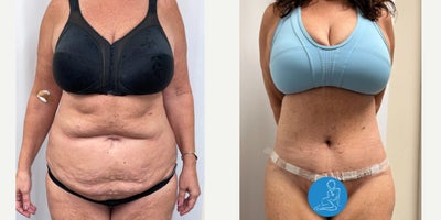 Tummy Tuck before and after photo