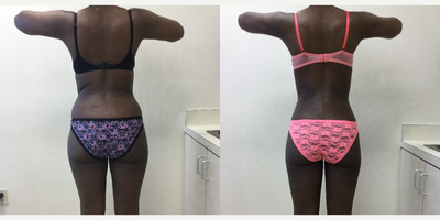Vaser Liposuction before and after photo