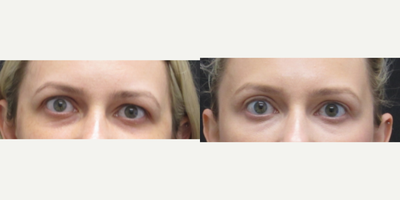 Eyelid Surgery before and after photo