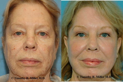 Facelift before and after photo