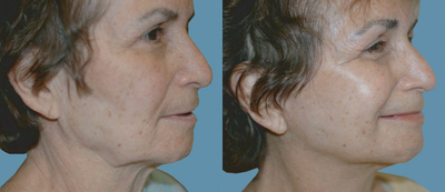 Facelift before and after photo