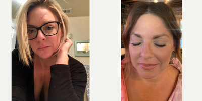 Fractora RF before and after photo