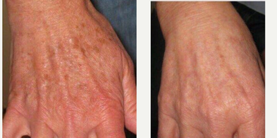 Laser Resurfacing before and after photo