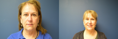 Rhinoplasty before and after photo