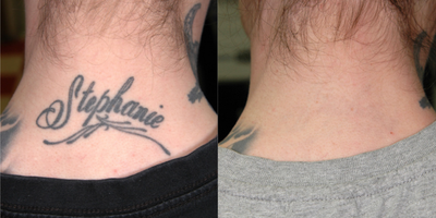Tattoo Removal before and after photo