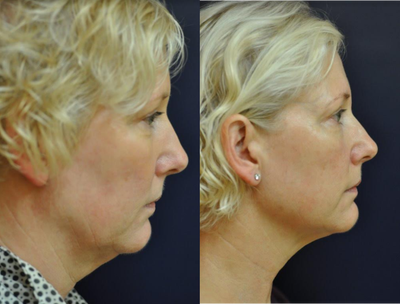 Ultherapy before and after photo